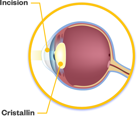 Retrait de la cataracte