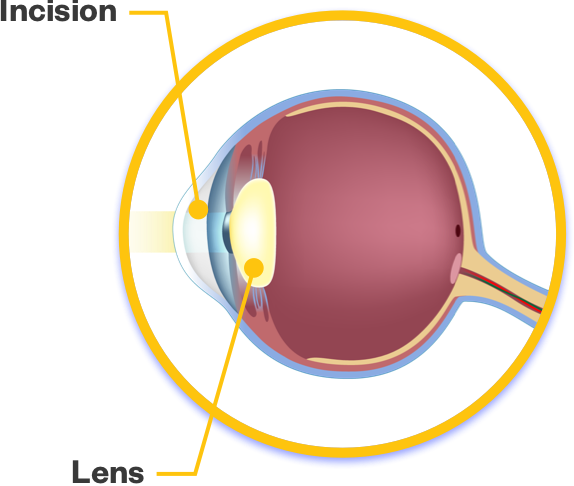 Cataract removal