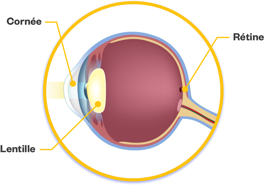 l’oeil avec cataracte