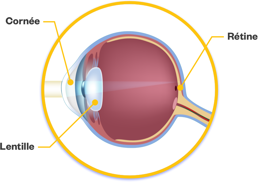 l’oeil sans cataracte