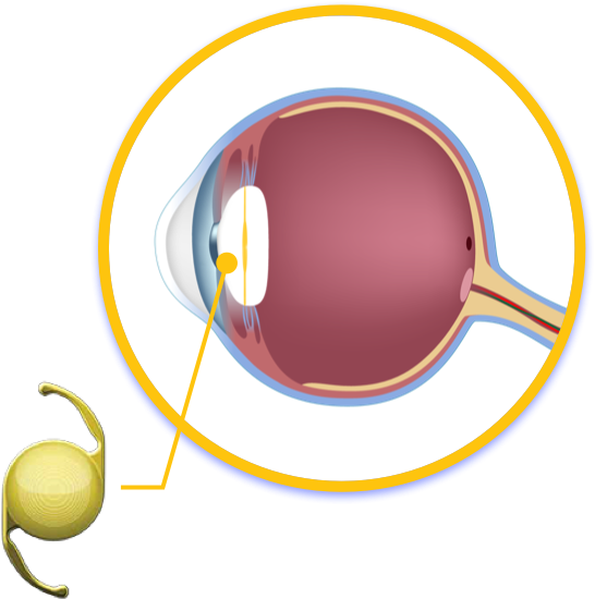 Insertion de la lentille cornéenne