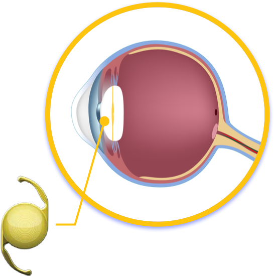 Lens insertion